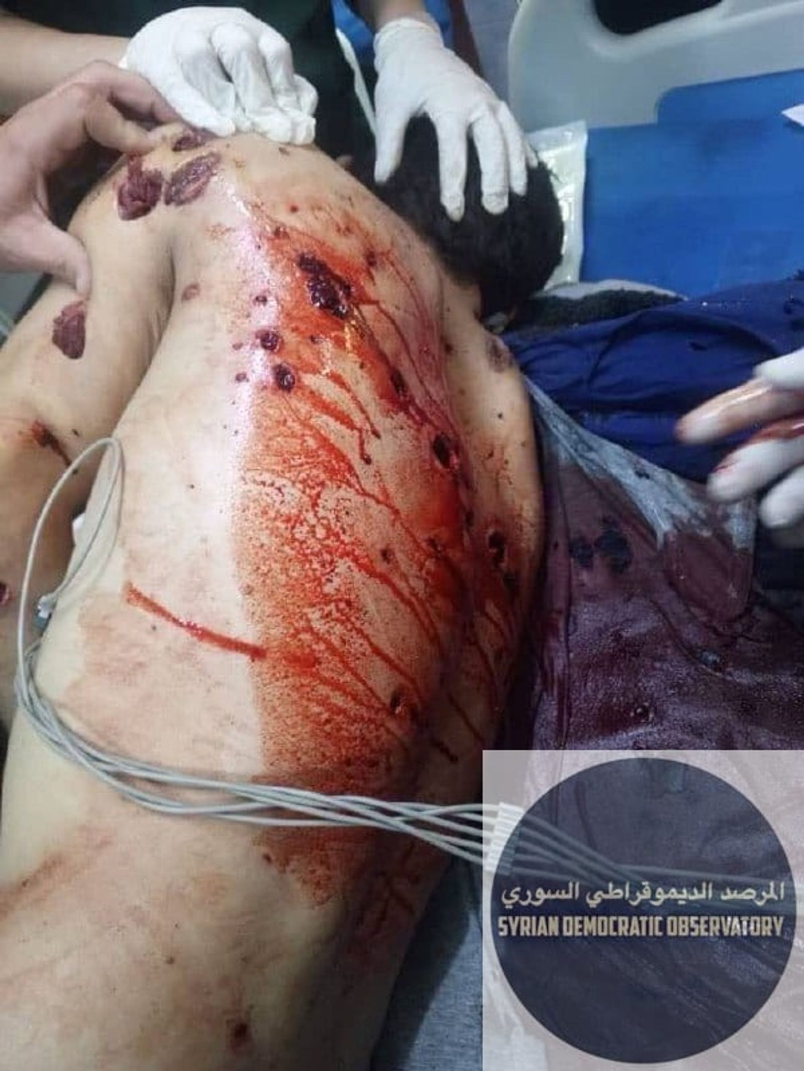 عشرات الإصابات من المدنيين الكورد بينهم نساء ورجال وأطفال رضع نتيجة القصف الهمجي الذي نفذت قوات تنظيم هيئة تحرير الشام الإرهابي على مدينة بأمر من القائد العام للقوات المسلحة في سوريا الإرهابي أبو محمد