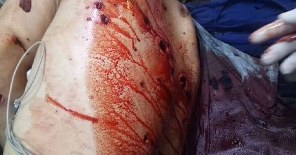 عشرات الإصابات من المدنيين الكورد بينهم نساء ورجال وأطفال رضع نتيجة القصف الهمجي الذي نفذت قوات تنظيم هيئة تحرير الشام الإرهابي على مدينة بأمر من القائد العام للقوات المسلحة في سوريا الإرهابي أبو محمد
